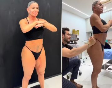 Famosos Gretchen mostra tratamento contra flacidez no rosto, pernas e bumbum