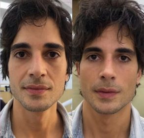 Fiuk passa por harmonização facial: veja antes e depois